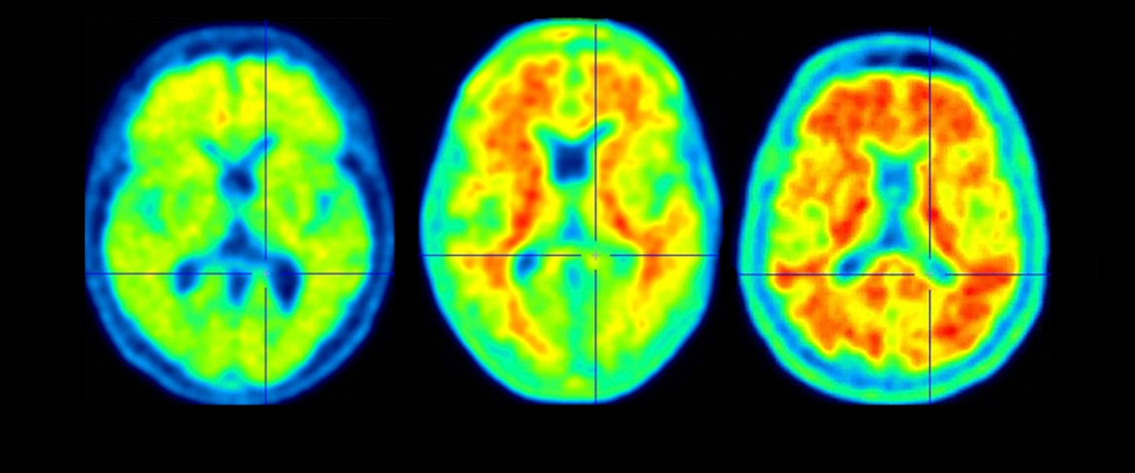 Exploring the Potential of Psilocybin in Alzheimer’s Disease Treatment